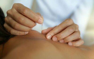 Dry Needling Benefits and More