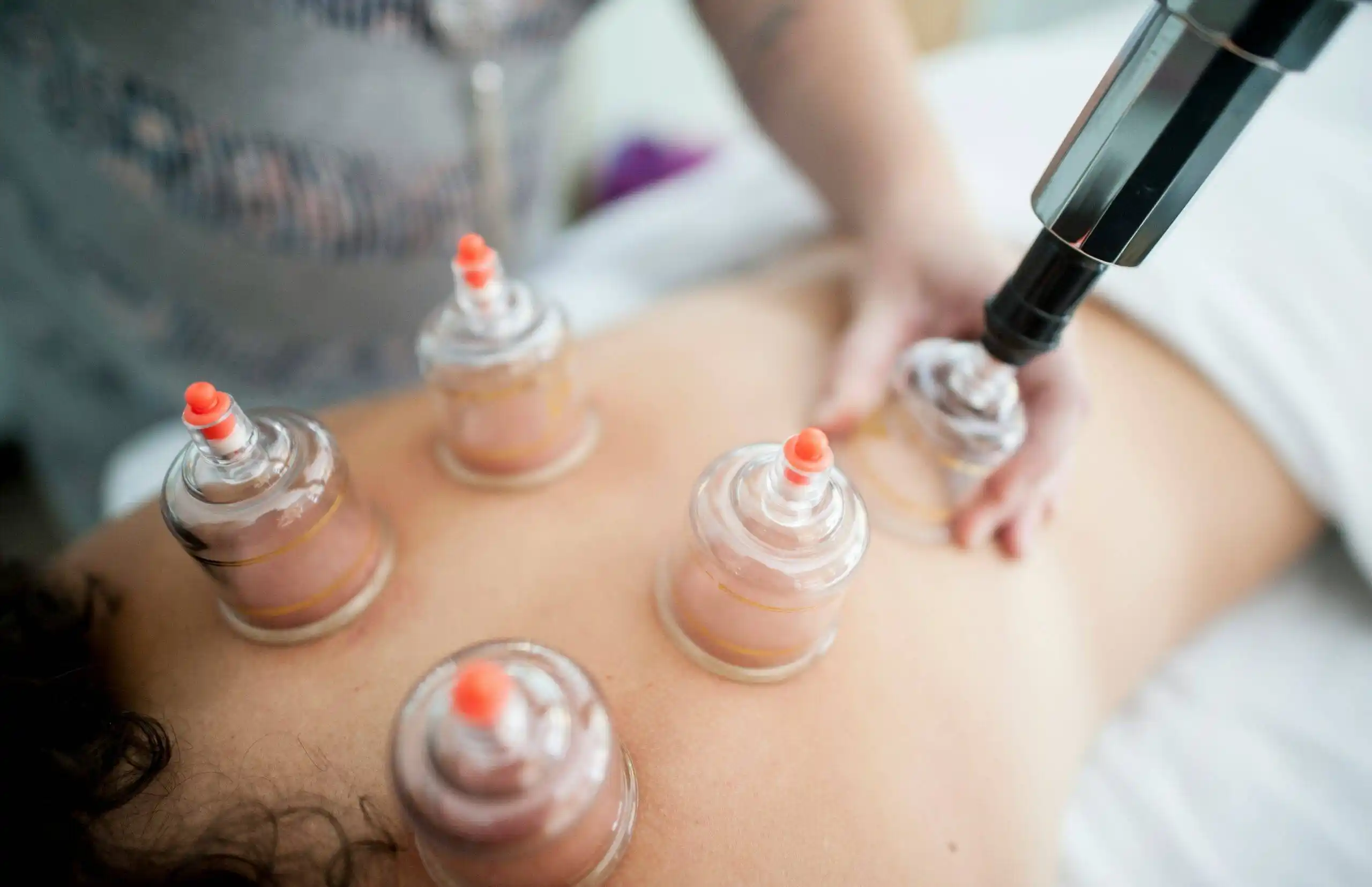 Graston Therapy vs. Cupping: Which One Is Better for Muscle Recovery?